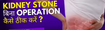 removing kidney stones naturally